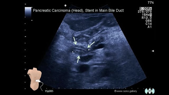 pancreatic cancer (bile duct stent)