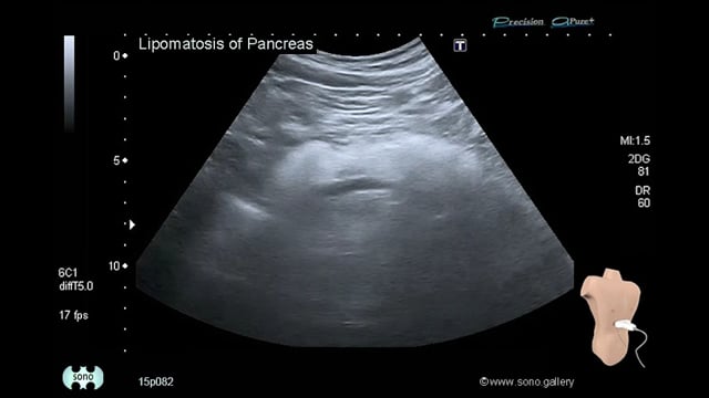 pancreatic lipomatosis