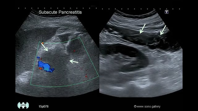 acute pancreatitis