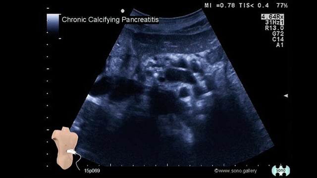 chronic pancreatitis