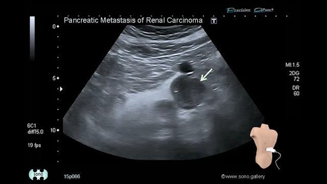 pancreatic metastasis of renal cell carcinoma