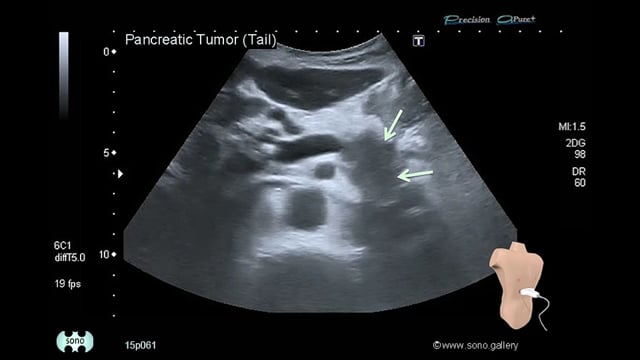 pancreatic cancer (tail)