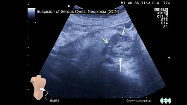 Serous Cystic Neoplasia (SCN)
