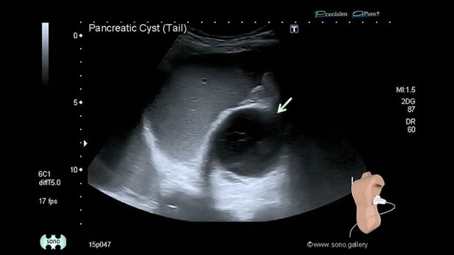 pancreatic pseudocyst