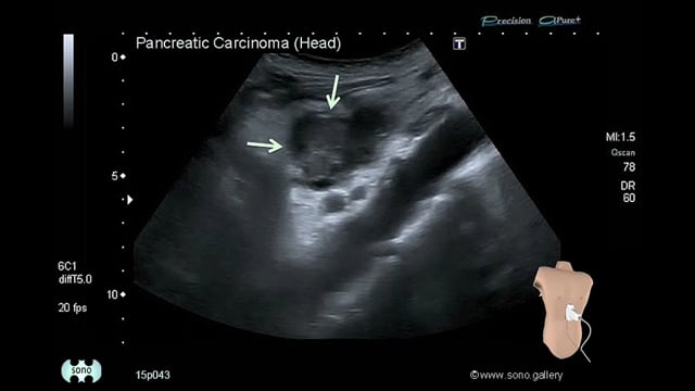 pancreatic cancer (head)