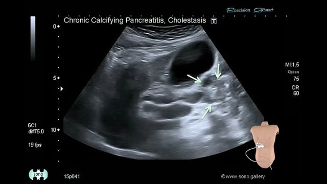 chronic pancreatitis, cholestasis