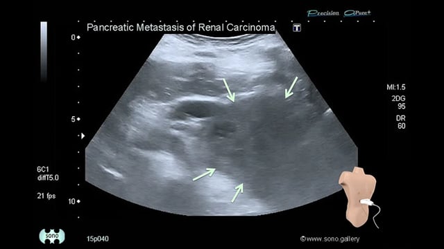 pancreatic metastasis of renal cell carcinoma