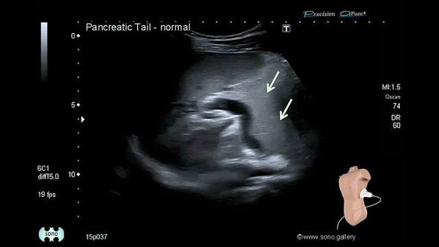 normal pancreas
