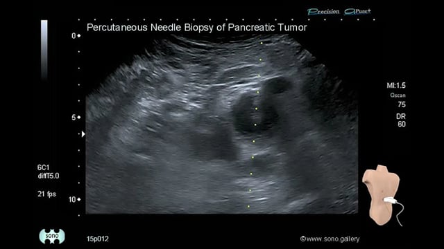 pancreatic cancer, biopsy