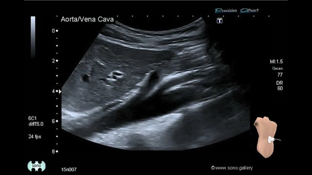 aorta, inferior vena cava