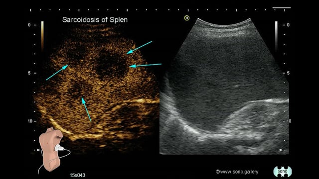 splenic sarcoidosis