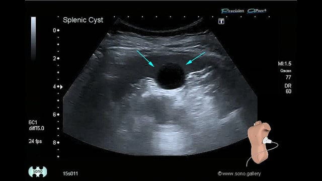 Splenic Cyst