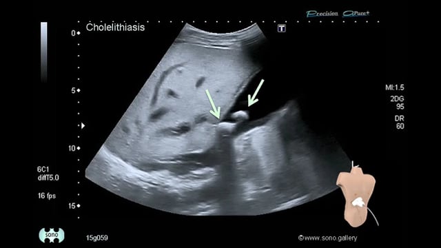 Cholelithiasis