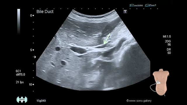 Bile Duct