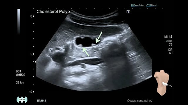 Cholesterol Polyp
