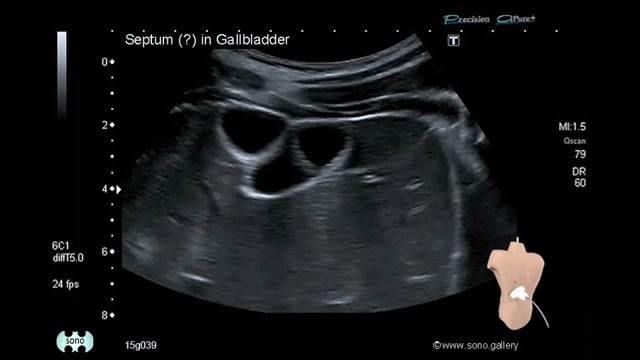 Septum (?) in Gallbladder