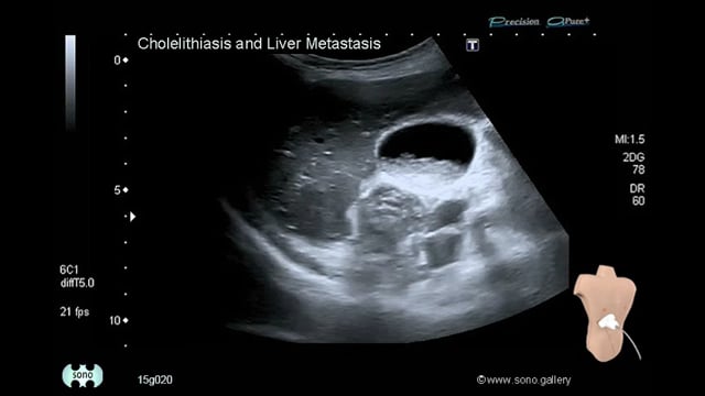 Cholelithiasis and Liver Metastasis