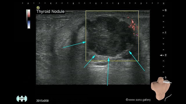 Thyroid Nodule