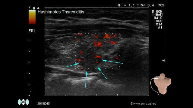Hashimoto’s thyroiditis