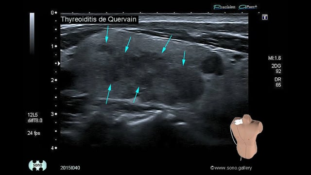 De Quervain’s thyroiditis