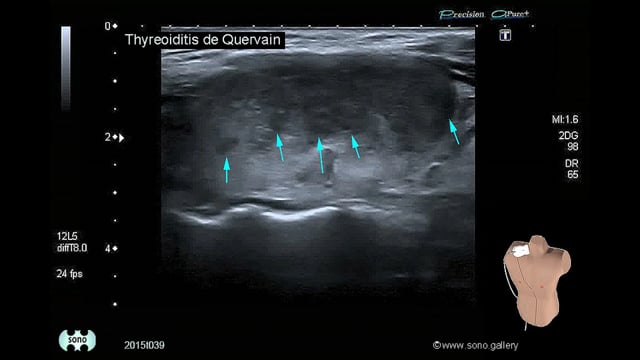 De Quervain’s thyroiditis