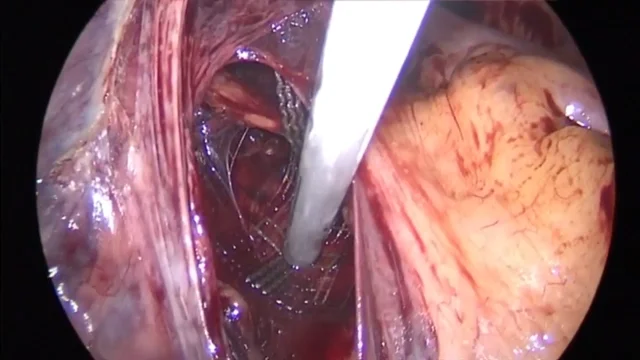 Total Autologous Fascia Lata Anterior and Apical Pelvic Organ