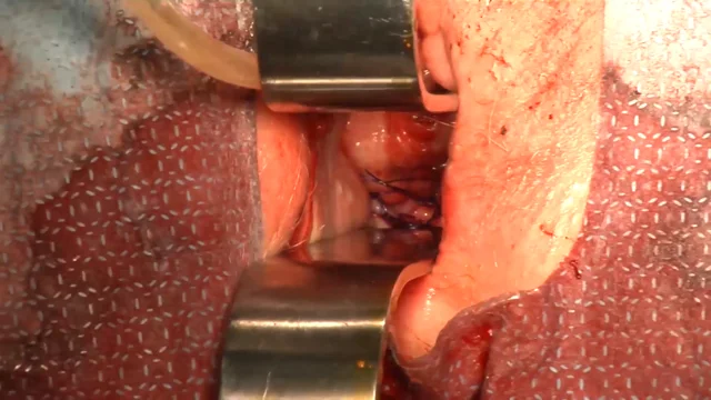 Total Autologous Fascia Lata Anterior and Apical Pelvic Organ