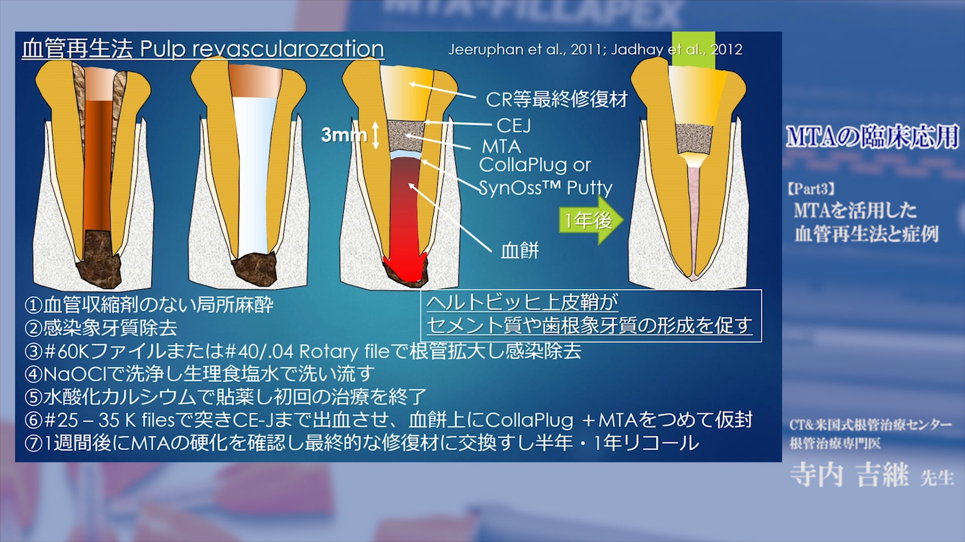 #3 MTAを活用した血管再生法と症例