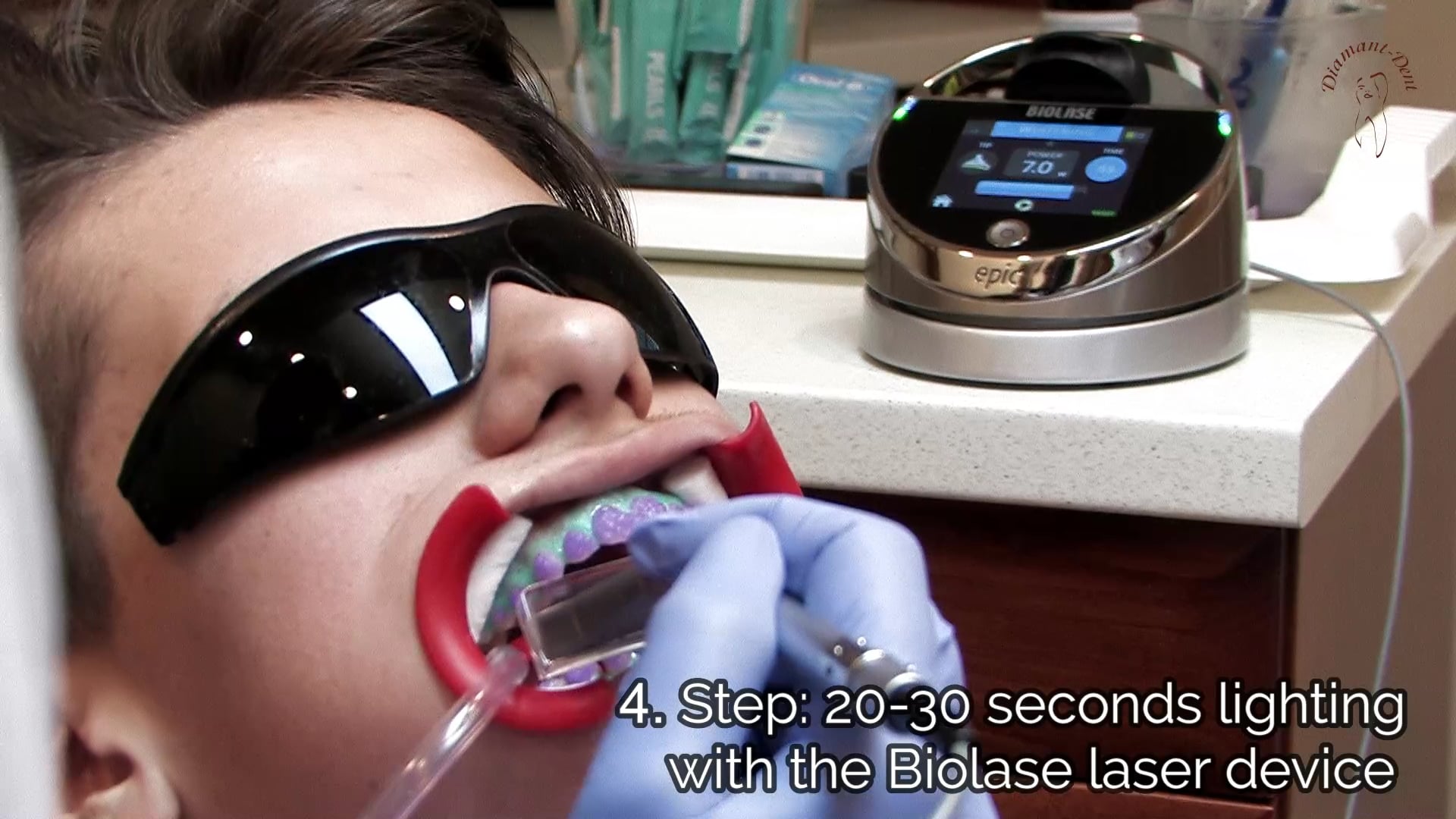 Bleaching with Biolase Laser, snowwhite teeth in 20 minutes! Dental
