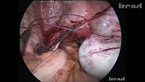 Ooforectomia esquerda laparoscópica com incisão única