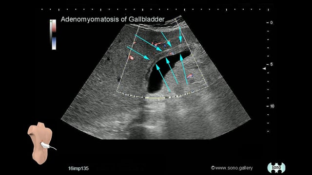 Adenomyomatosis of Gallbladder