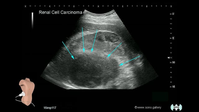 Renal Cell Carcinoma (RCC)