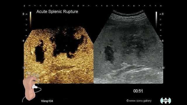splenic rupture