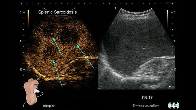 sarcoidosis