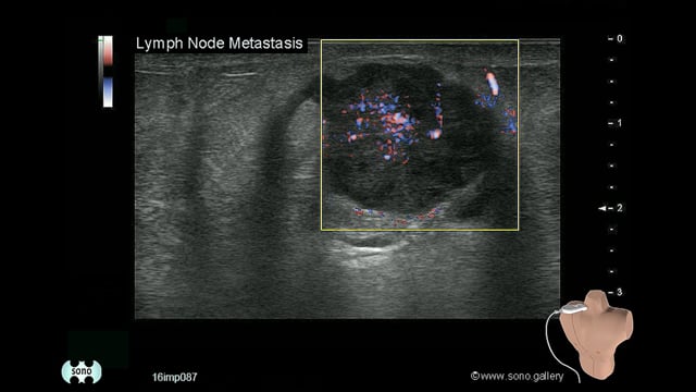 Lymph Node Metastasis
