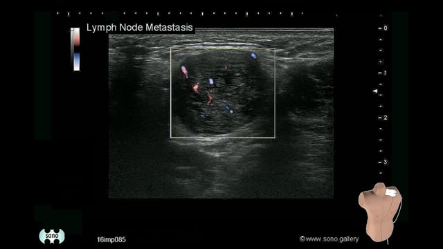 Lymph Node Metastasis