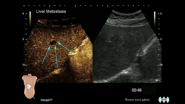 Liver Metastasis