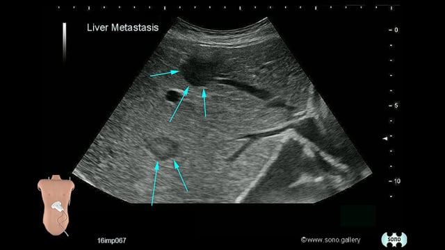 Liver Metastasis