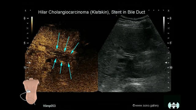 Klatskin´s tumor