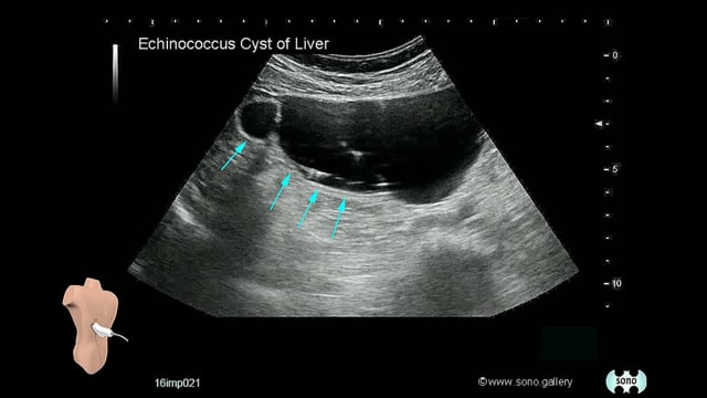 Echinococcus Cyst of the Liver