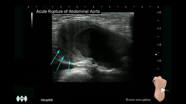 ruptured abdominal aortic aneurysm (AAA)