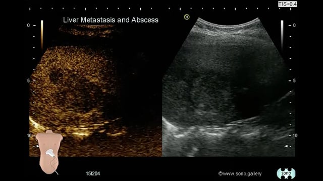 Liver Metastasis and Abscess