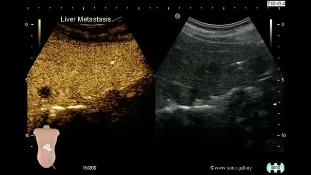 Liver Metastasis