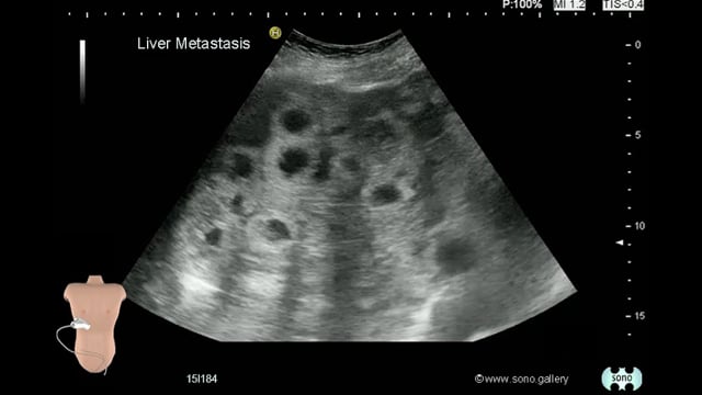 Liver Metastasis