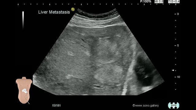 Liver Metastasis