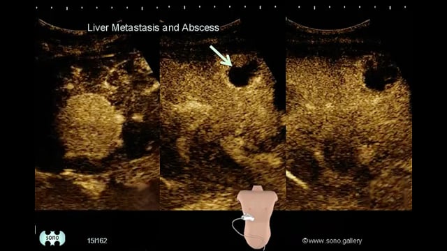 Liver Metastasis and Abscess