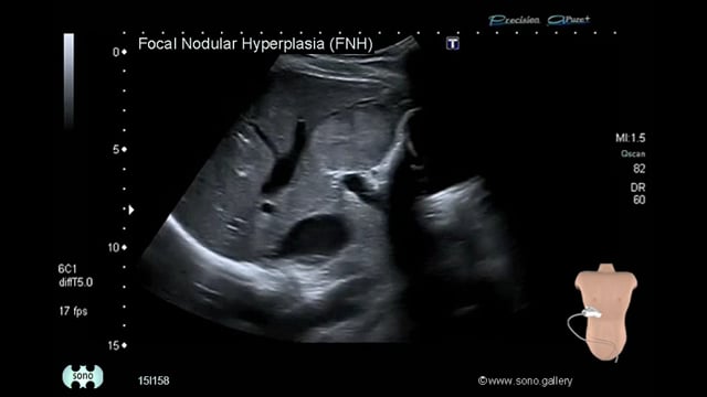 Focal Nodular Hyperplasia (FNH)