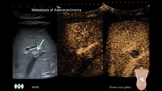 Metastasis of Adenocarcinoma