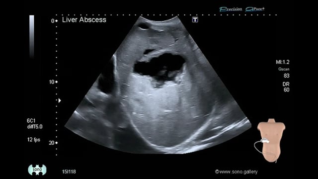 Liver Abscess