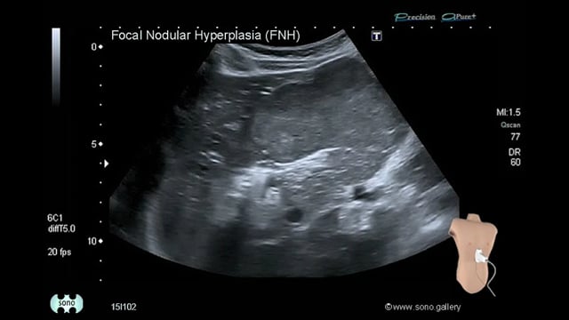 Analgesic Nephropathy - SONO.GALLERY